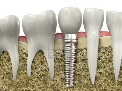 8920098 very high resolution 3d rendering of a dental implant