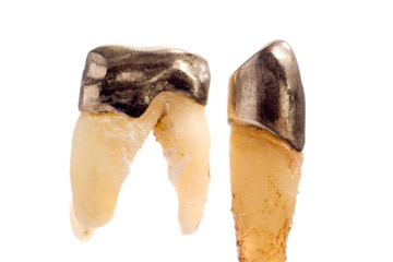 dental crowns 1