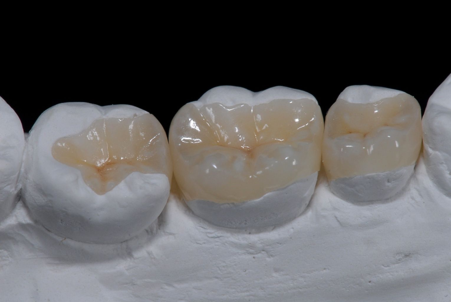 inlays 202